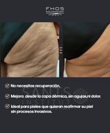 Fhos Corporal - 5 sesiones + 1 de regalo