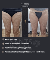 Fhos Corporal - 5 sesiones + 1 de regalo