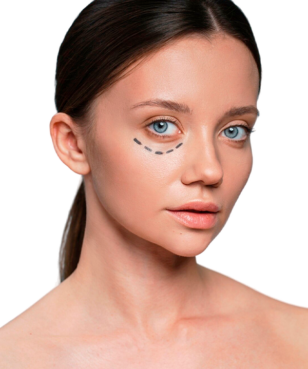 Relleno de Ojeras